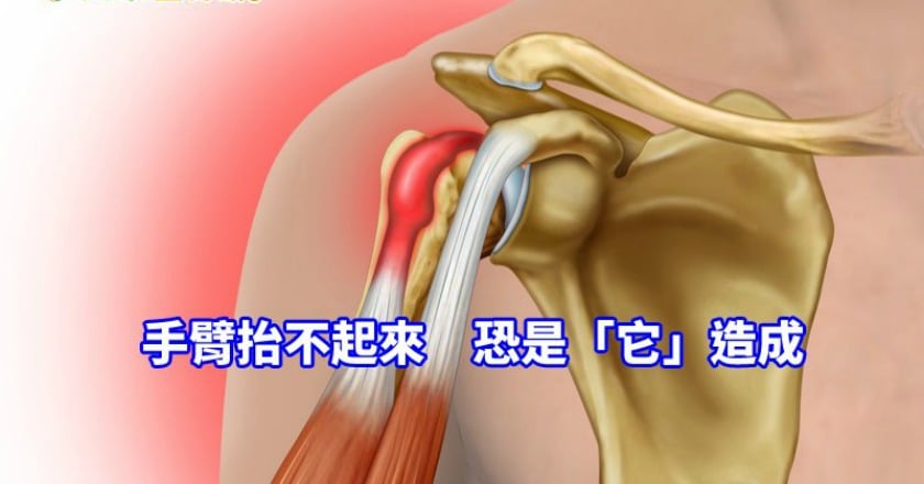 手臂抬不起來　會不會是「旋轉肌袖」斷裂了？