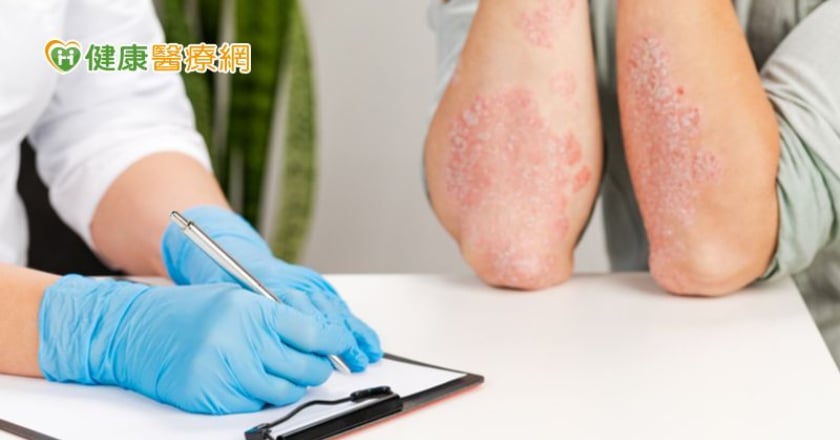 世界乾癬日:兼顧皮表乾癬與併發症 落實全方位健康管理
