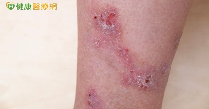 被蚊蟲咬想止癢別用偏方 醫師傳授夏季皮膚保養4原則
