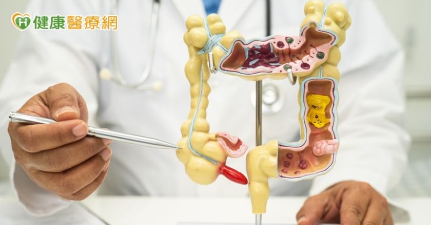 腸癌「TNT治療」保留肛門！適用癌友多