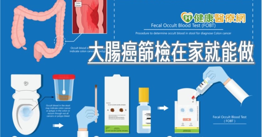 大腸癌篩檢在家就能做 定期2年1次你做了沒?