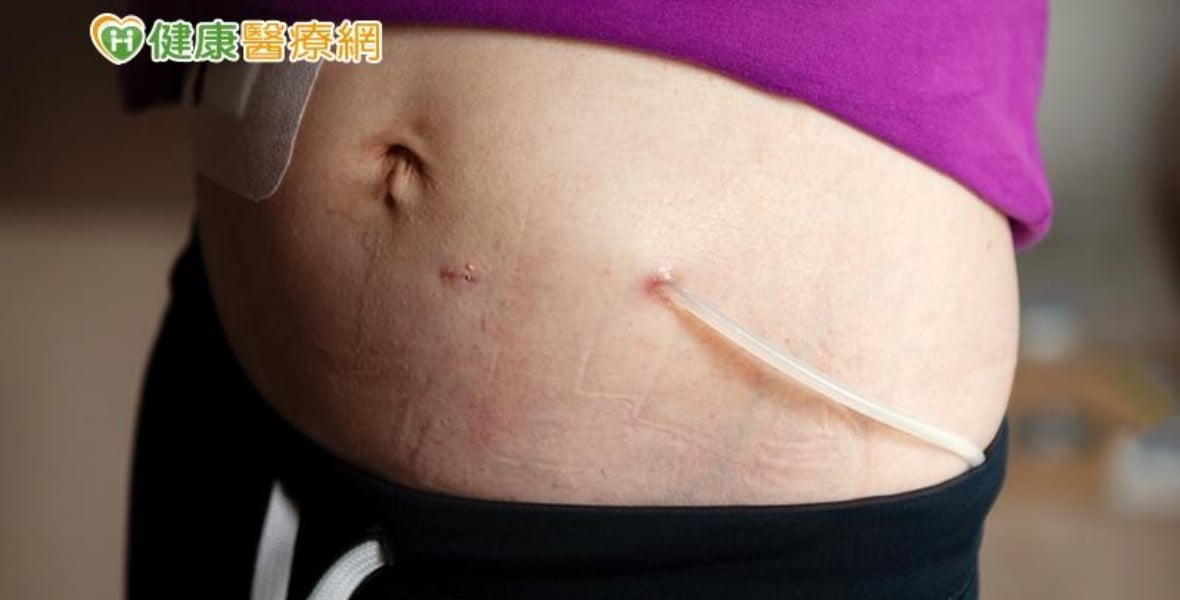 【洗腎專題】生、心理雙重煎熬！腎友協會籲：別吝嗇尋求協助