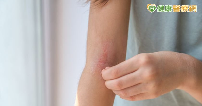 抓了又癢、癢了又抓 高鹽飲食恐增加濕疹風險?
