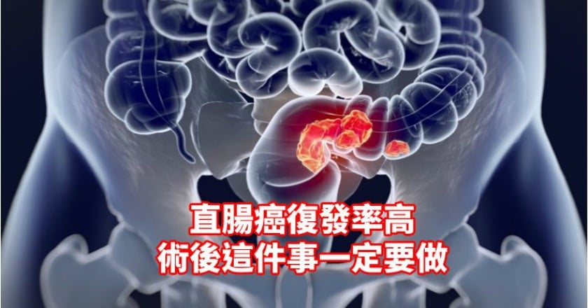 直腸癌復發率高 術後這件事一定要做