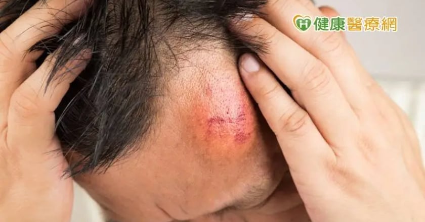 50歲男頭部莫名腫脹滲出膿血，竟是惡性骨肉瘤！ 醫：2年齡易發生
