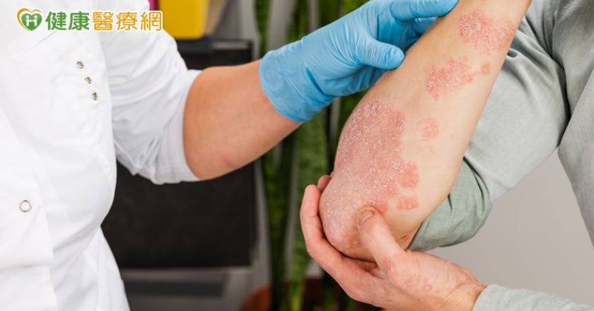 不是一般乾癬!「全身膿疱性乾癬」恐致器官衰竭 勿輕忽皮膚膿疱、脫屑