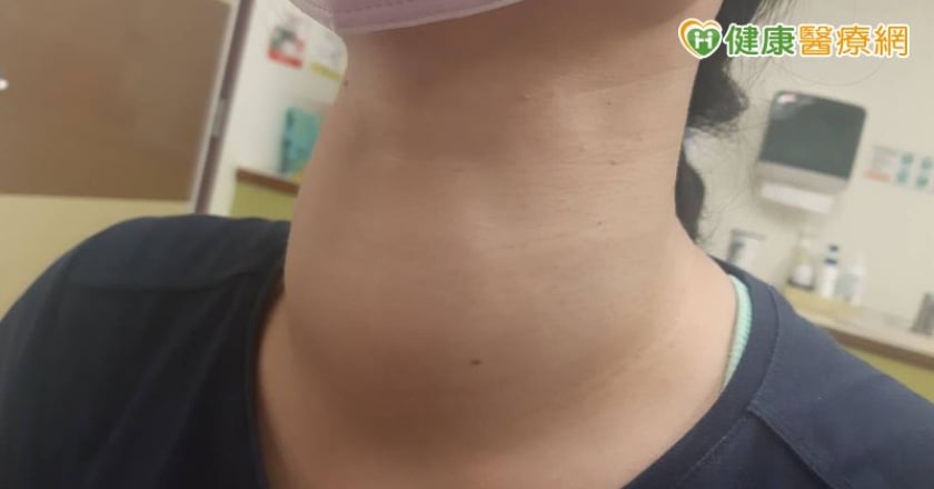 雙十年華卻出現「大脖子」 原來是這1疾病惹的禍！