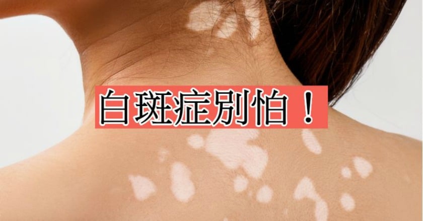 臉現白斑引異樣目光　治療後找回本來面貌