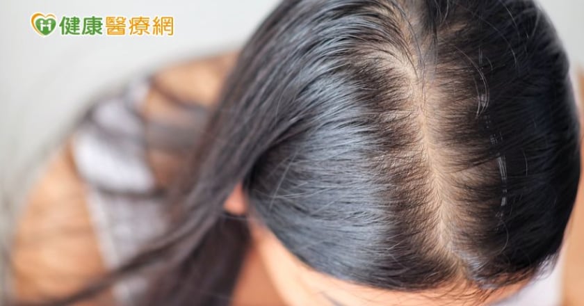 頭頂分線變寬、髮量稀疏　我的頭髮發生什麼事情了？