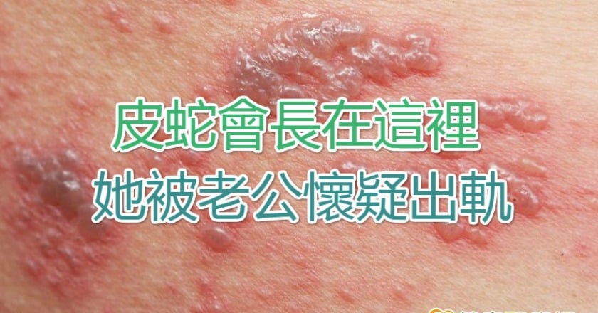 皮蛇會長在這裡　她被老公懷疑出軌