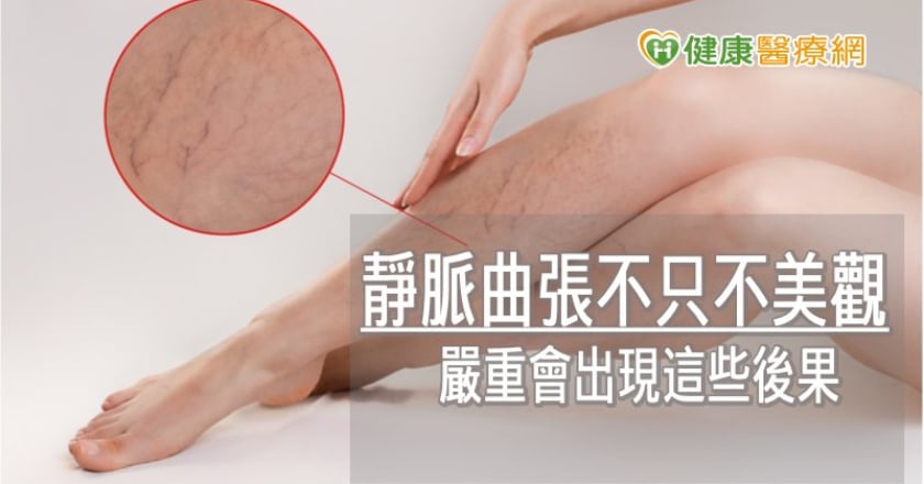 靜脈曲張不只不美觀 嚴重會出現這些後果