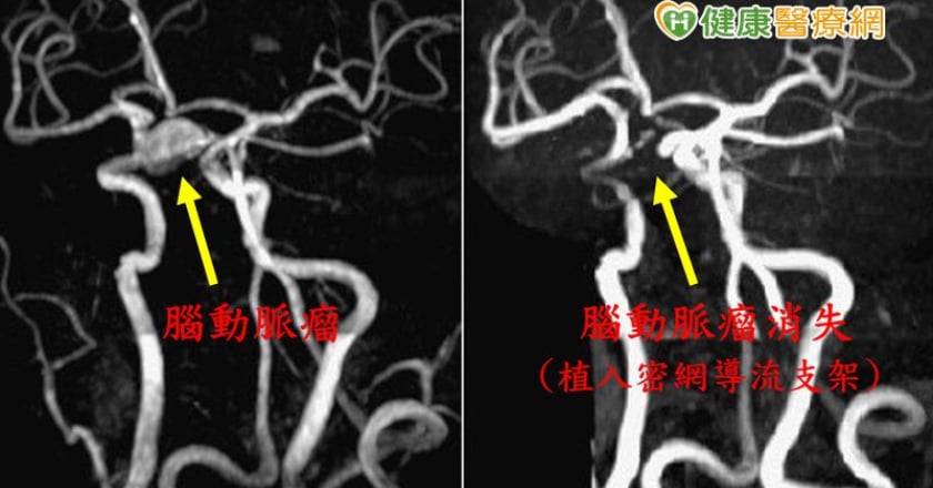 2/3腦動脈瘤破裂非死即殘！最新治療遠離死神威脅