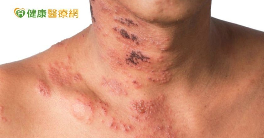 年關將近,忙到焦頭爛額 小心免疫力低下,皮蛇趁虛而入!