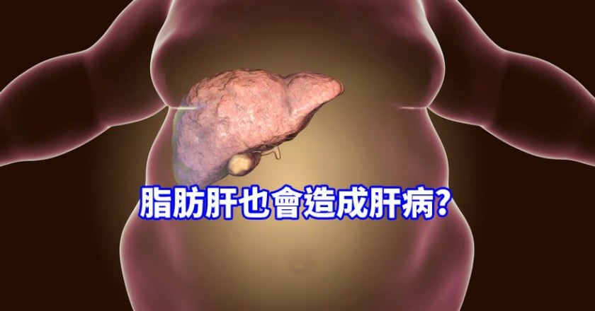「非酒精性脂肪肝」恐成肝炎？這類型肥胖須當心
