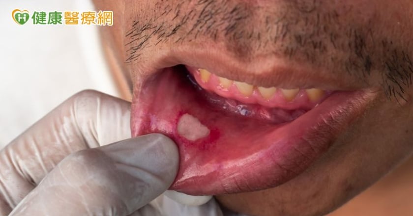 他齒齦潰瘍以為牙周病，檢查竟是T4b口腔癌！ 中醫大附醫「創新療法」助維持咬合
