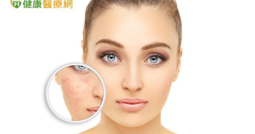 酒糟肌慢性泛紅 可用染料雷射來調理
