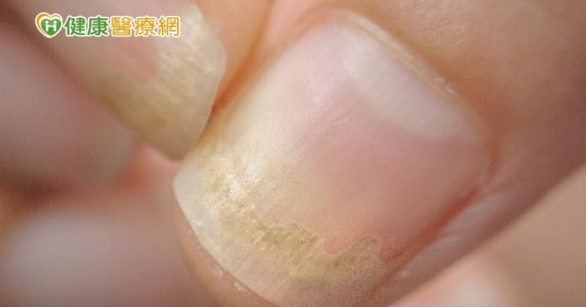 指甲變色、變厚、變形不一定是灰指甲! 「這些」都可能產生指甲症狀