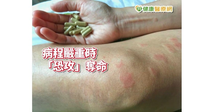 紅斑性狼瘡發病　33次血漿置換救她一命