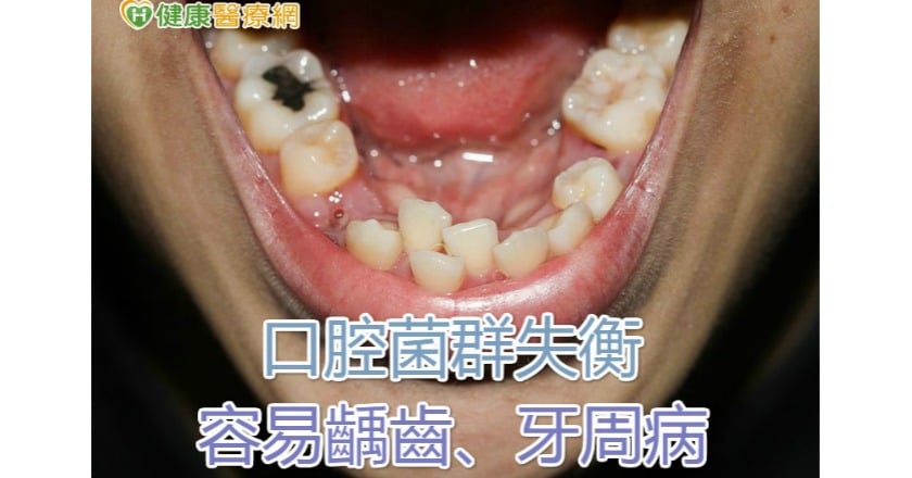 口腔菌群失衡 容易齲齒、牙周病