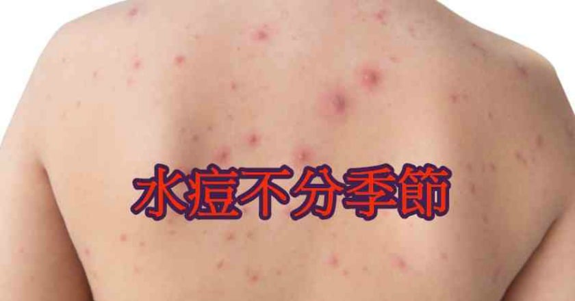 水痘不可掉以輕心！ 國小族群感染比例占最高