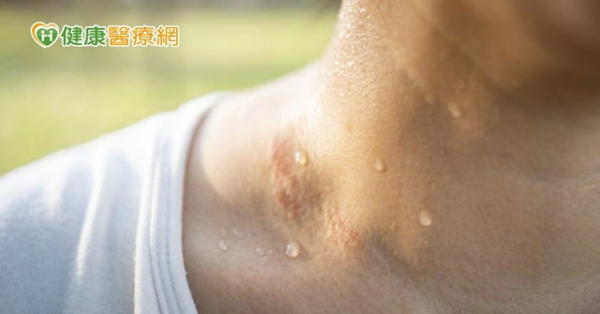 夏季水分流失快！　腎結石該怎麼辦？